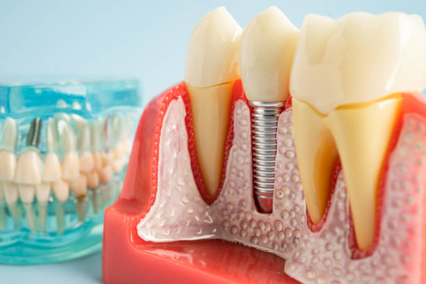 Best Root Canal Treatment  in Chamberlain, SD